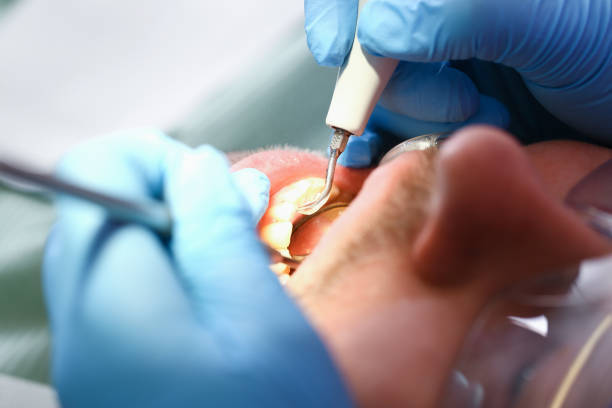 Best Chipped Tooth Repair Near Me  in Schulenburg, TX